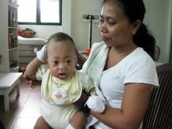 Thomas_bandage_removed